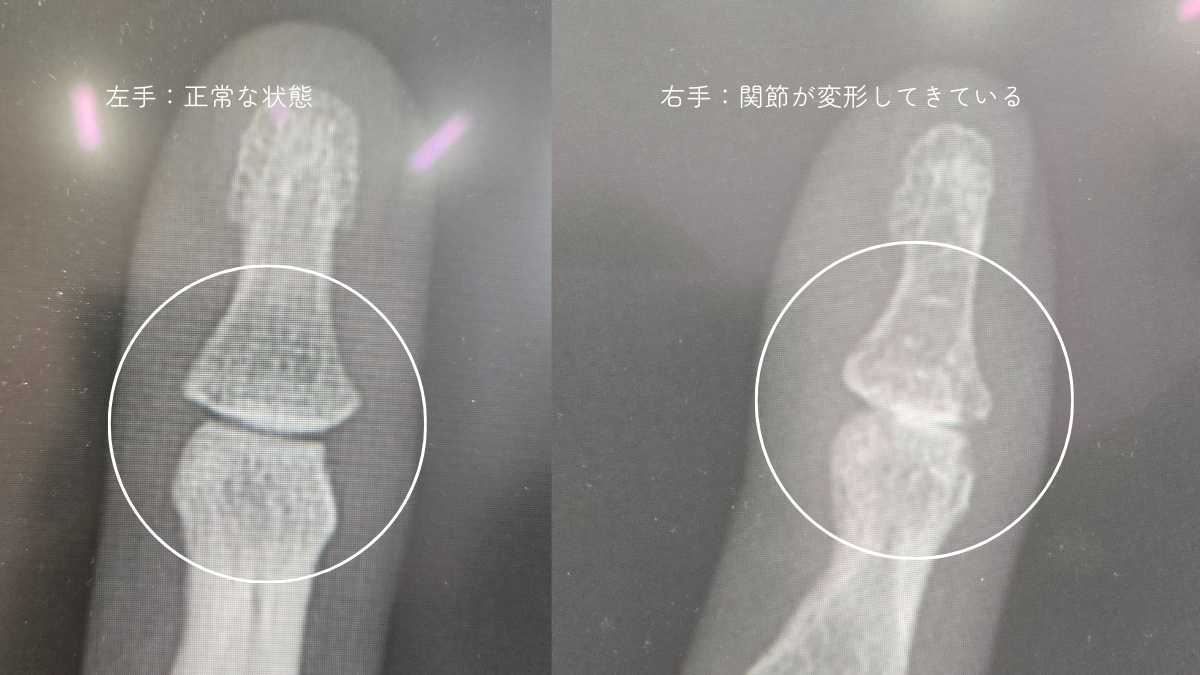 右手小指のレントゲン写真